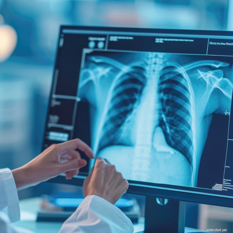 weibliche Person in weißer Krankenhausarbeitskleidung betrachtet ein Röntgenbild der mesnschlichen Lunge am Monitor